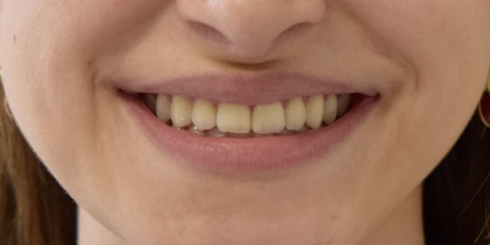Dientes alineados, después