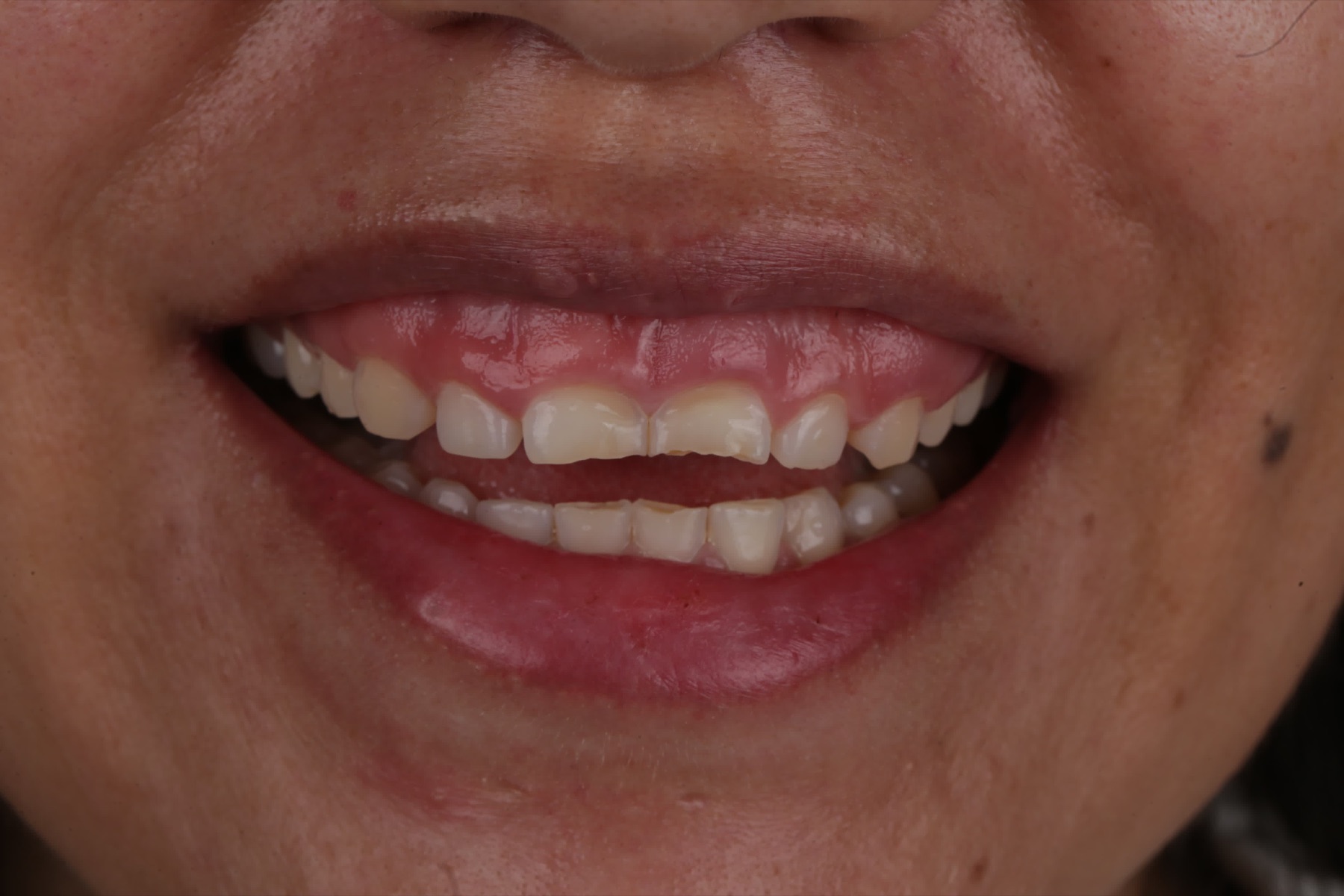 Sonrisa con encía que cubre parte de los dientes, antes