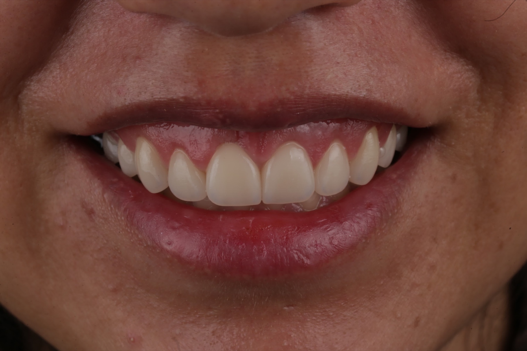 Sonrisa con nuevo contorno de encía, después